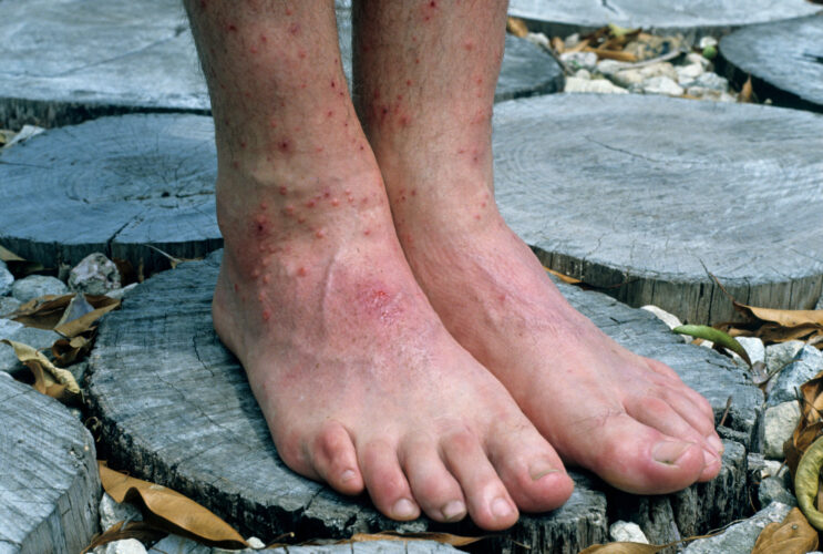 What to Do for Chigger Bites